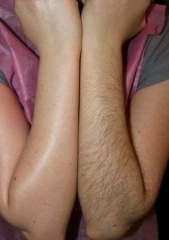 Full Body Laser Hair Removal